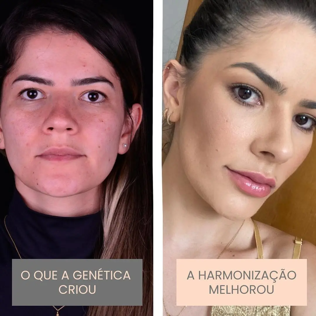 Antes e depois de harmonização orofacial em Goiânia — caso 4, Studio Dental