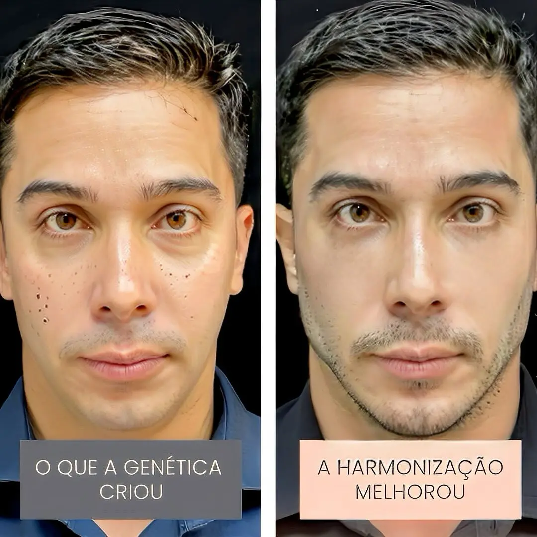Antes e depois de harmonização orofacial em Goiânia — caso 5, Studio Dental