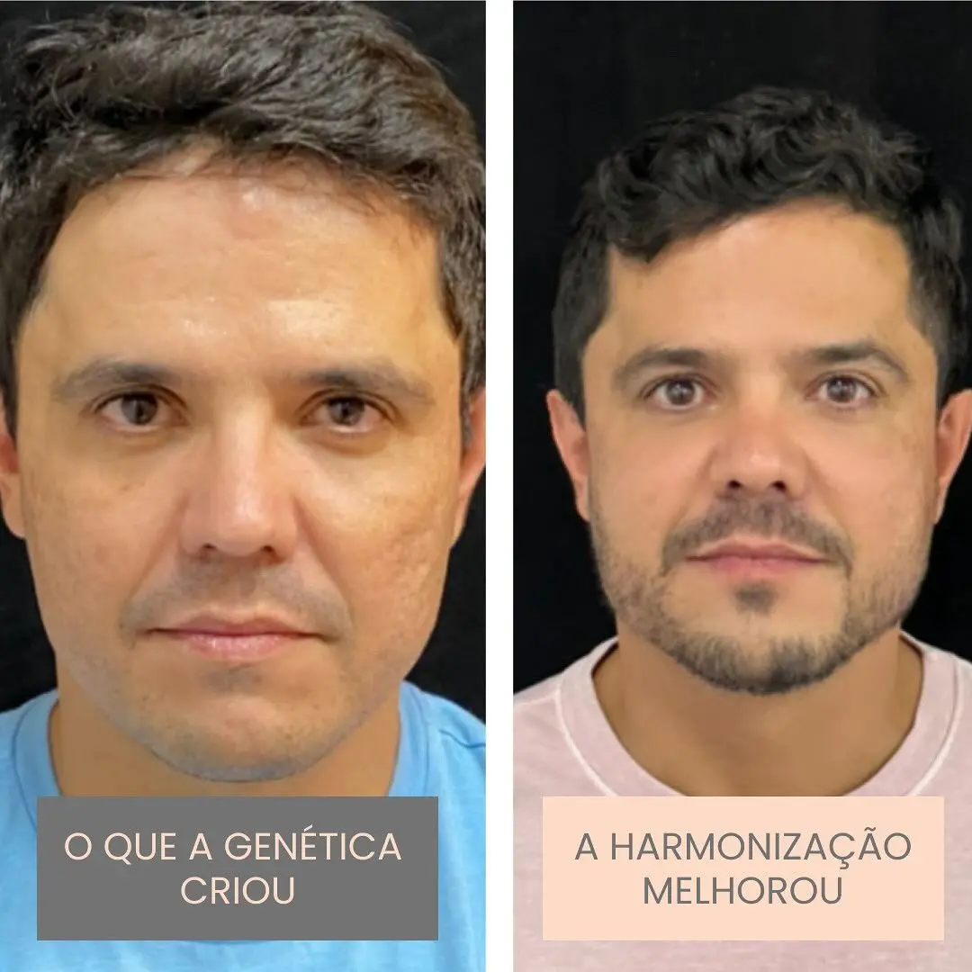 Antes e depois de harmonização orofacial em Goiânia — caso 7, Studio Dental