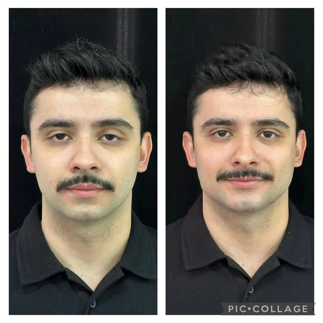Antes e depois de harmonização orofacial em Goiânia — caso 8, Studio Dental